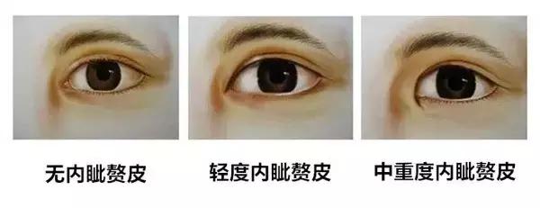为什么网红几乎都喜欢做开眼角? 为什么网红几乎都喜欢做开眼角?